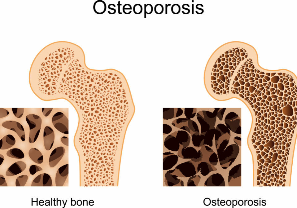 Osteoporosis